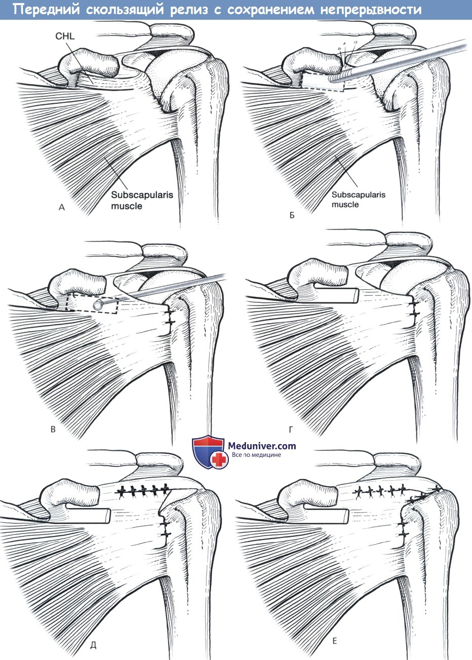 Разрыв сухожилия надостной мышцы плечевого сустава операция