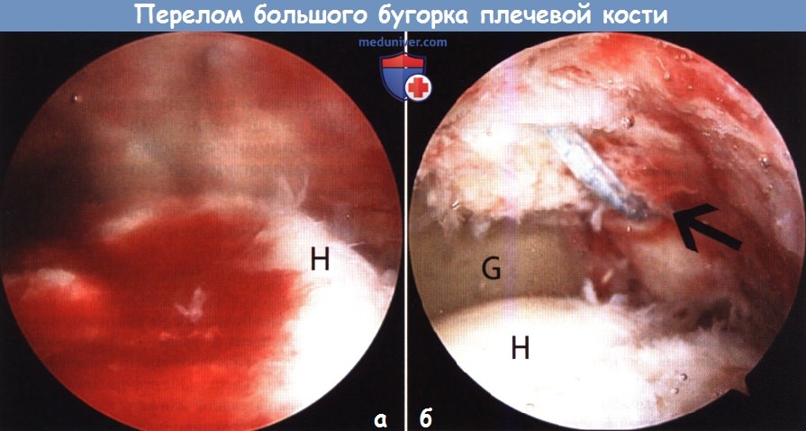Артроскопическая операция при переломе бугорка плечевой кости