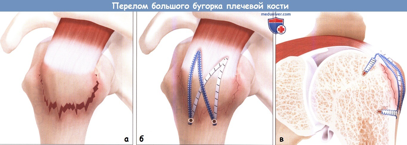 Артроскопическая операция при переломе бугорка плечевой кости