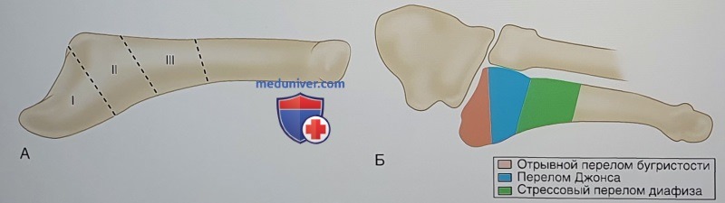 Открытая репозиция и внутренняя фиксация проксимальных переломов пятой плюсневой кости стопы (перелома Джонсона, стрессового перелома)