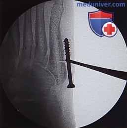 Открытая репозиция и внутренняя фиксация проксимальных переломов пятой плюсневой кости стопы (перелома Джонсона, стрессового перелома)
