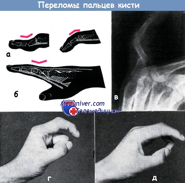 Переломы пальцев кисти