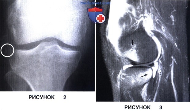 Показания, подготовка к первичной реконструкции передней крестообразной связки (ПКС) коленного сустава