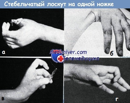 Пластика дефекта кончика пальца стебельчатым лоскутом