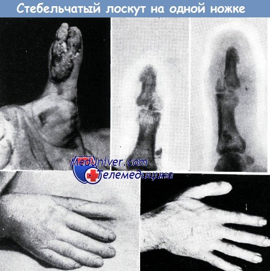 Пересадка кожи пальцев рук thumbnail