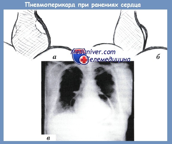 Рентгенодиагностика ранений сердца - пневмоперикард