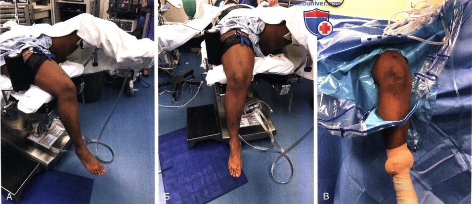 Показания и подготовка к артроскопии коленного сустава