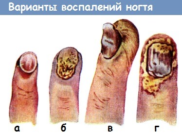 Варианты воспаления ногтя