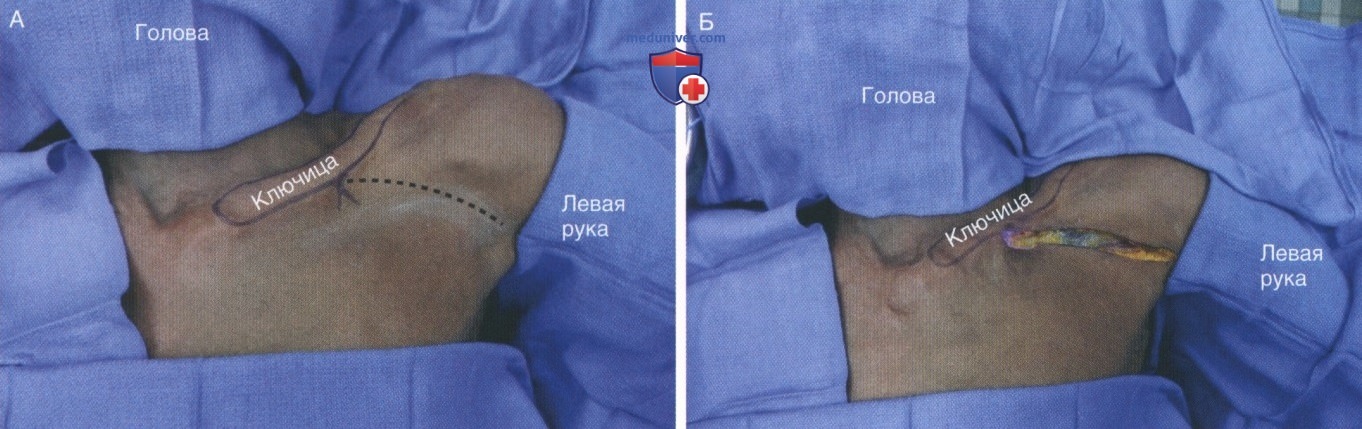 Техника, этапы операции при повреждении подмышечных сосудов - артерий, вен