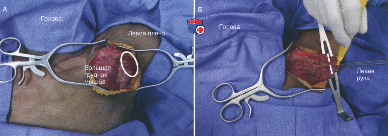 Техника, этапы операции при повреждении подмышечных сосудов - артерий, вен