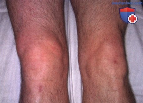 Повреждения менисков коленного сустава