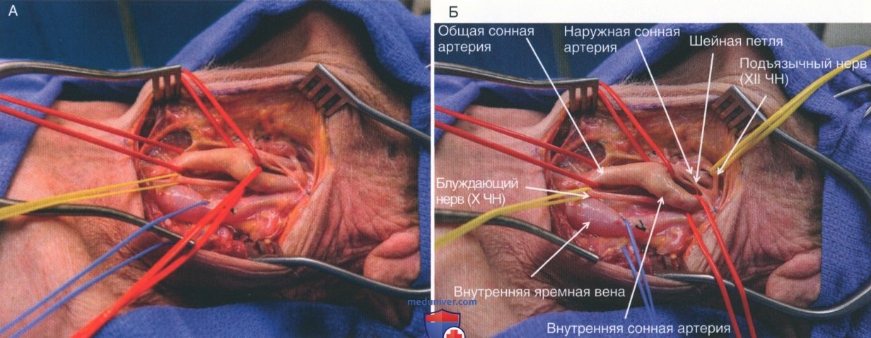 Техника, этапы операции при повреждении сонных артерий и внутренних яремных вен