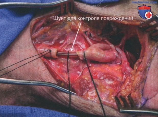 Техника, этапы операции при повреждении сонных артерий и внутренних яремных вен