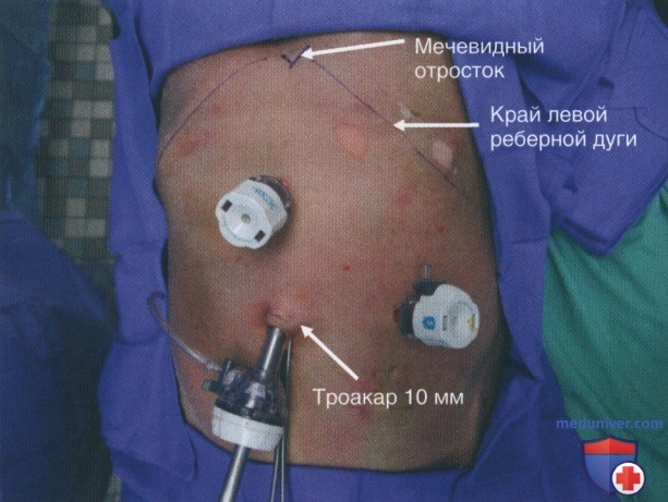 Техника, этапы операции при повреждении диафрагмы