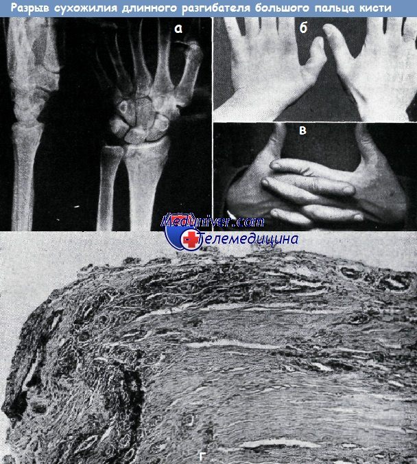 Повреждение длинного разгибателя большого пальца кисти при переломе лучевой кости