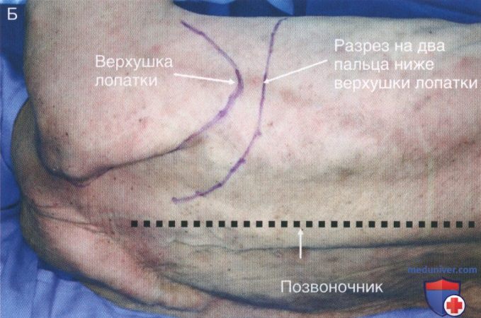 Техника, этапы операции при повреждении грудного отдела пищевода