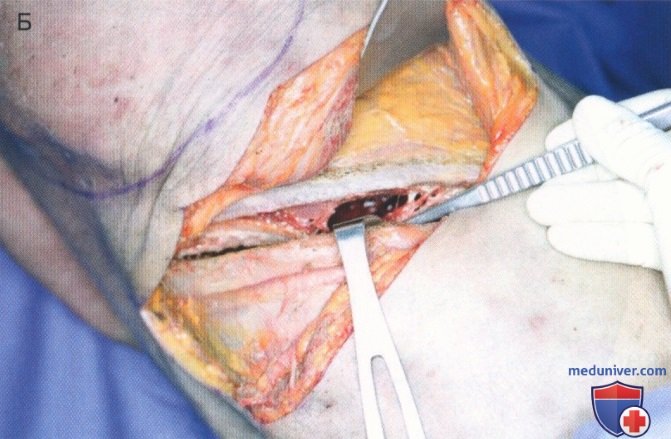 Техника, этапы операции при повреждении грудного отдела пищевода