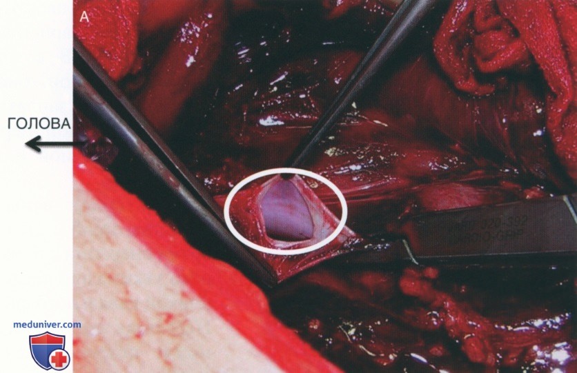 Техника, этапы операции при повреждении нижней полой вены