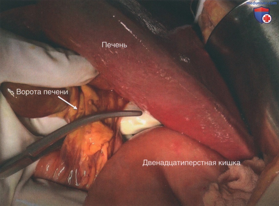 Техника, этапы операции при повреждении нижней полой вены