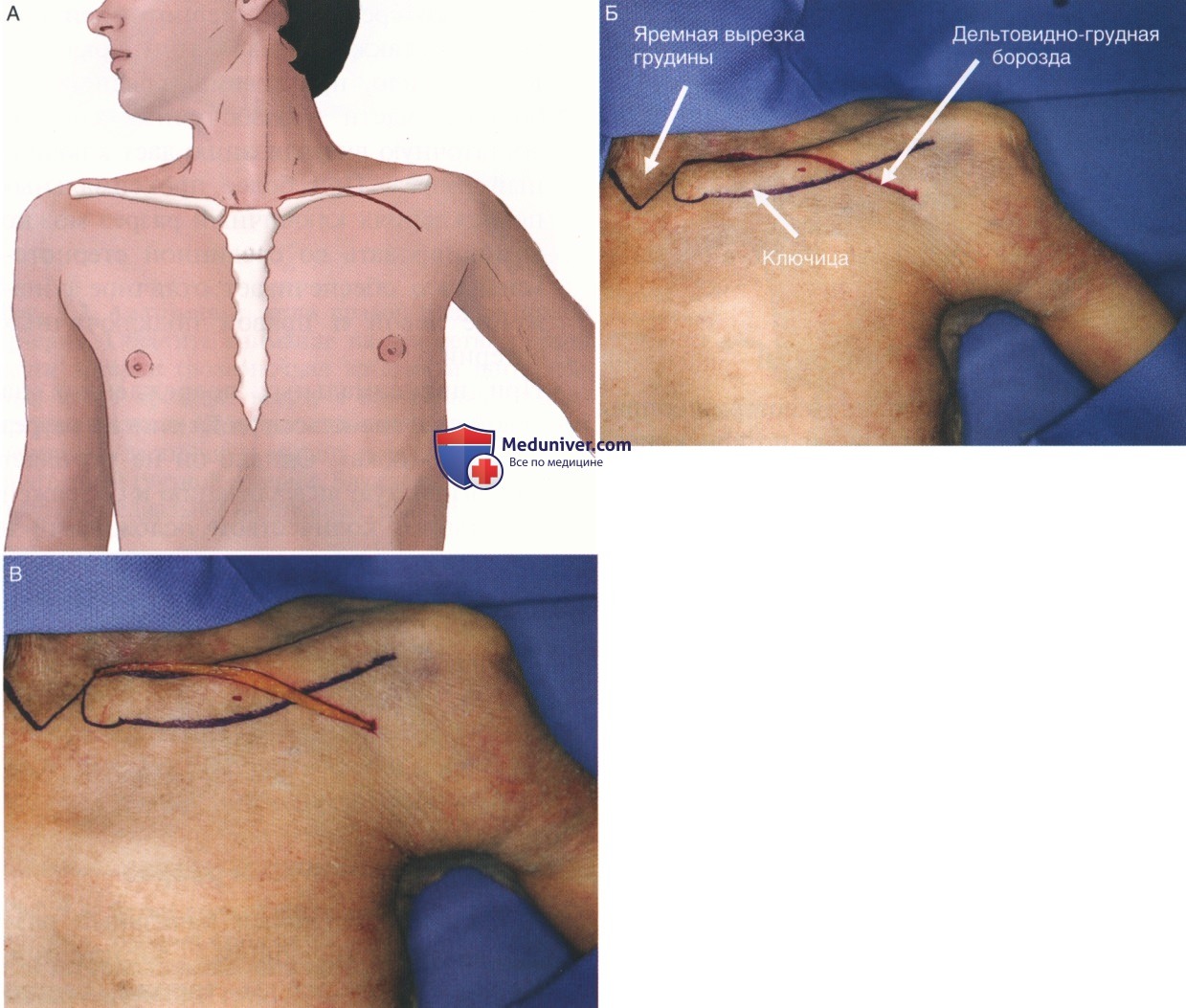 Техника, этапы операции при повреждении подключичных сосудов - артерий, вен