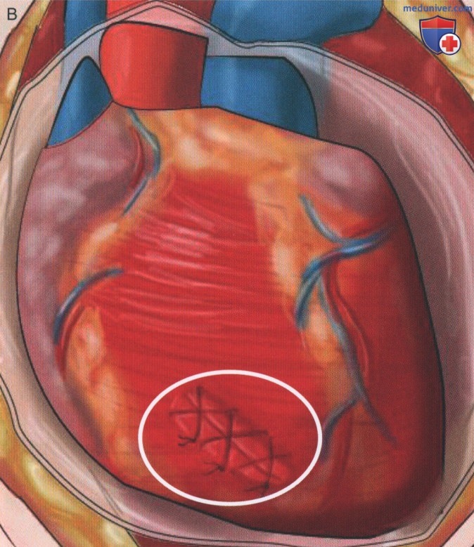 Техника, этапы операции при повреждении сердца