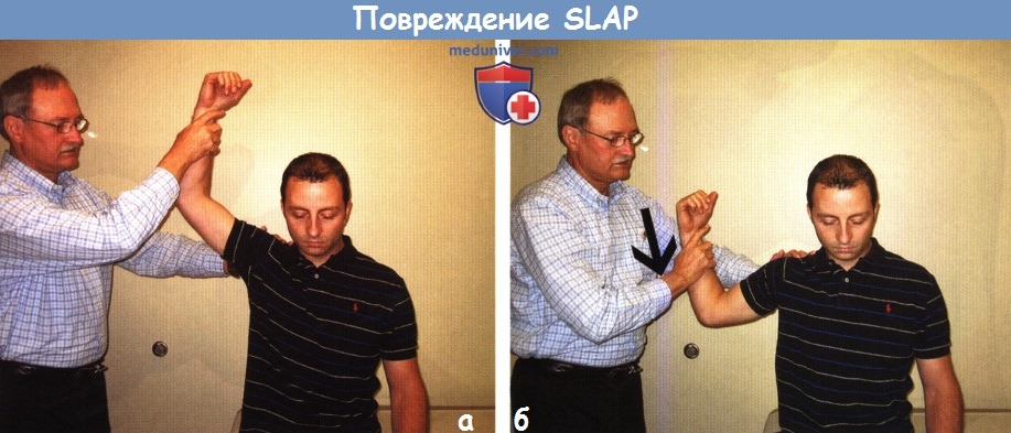 Повреждение SLAP плечевого сустава