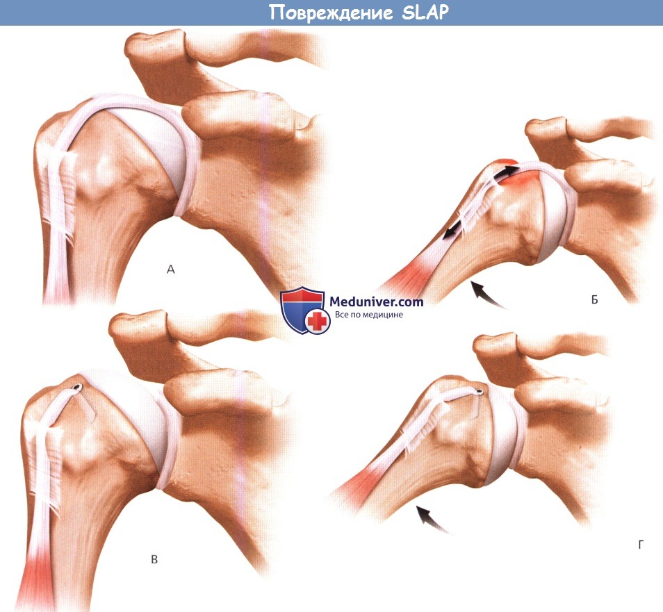 Плечевая губа суставная разрыв. Слэп повреждение плечевого сустава. Slap синдром плечевого сустава операция. Slap синдром плечевого сустава классификация.