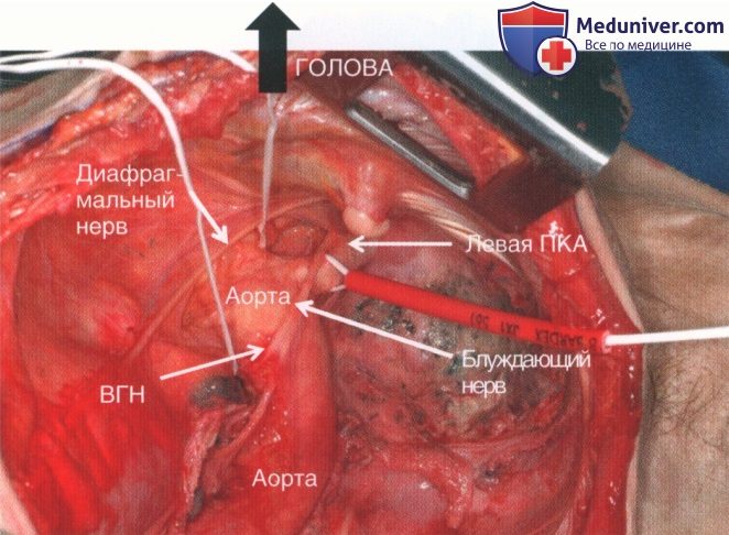 Техника, этапы операции при повреждении кровеносных сосудов грудной клетки