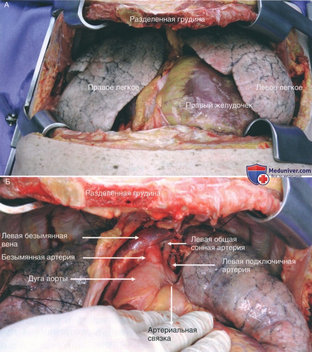 Техника, этапы операции при повреждении кровеносных сосудов грудной клетки