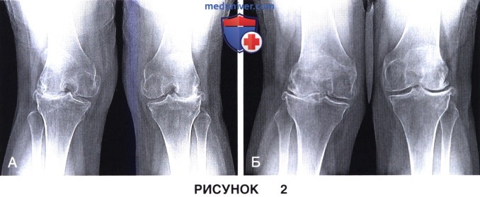 Показания, подготовка к позиционированию компонентов протеза коленного сустава