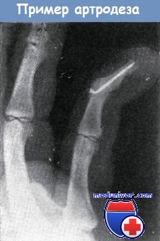 Спица в кости при переломе фото thumbnail