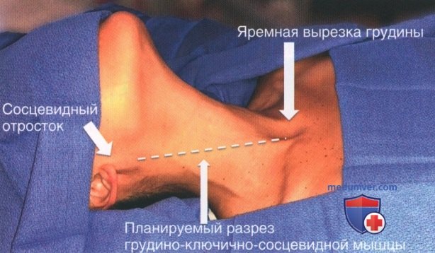 Операция на шее при травме