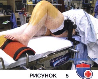 Показания, подготовка к тотальному эндопротезированию коленного сустава в условиях варусной деформации