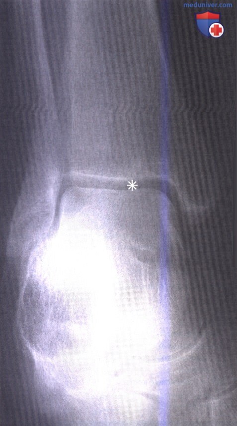 Примеры рентгенограмм голеностопного сустава и стопы