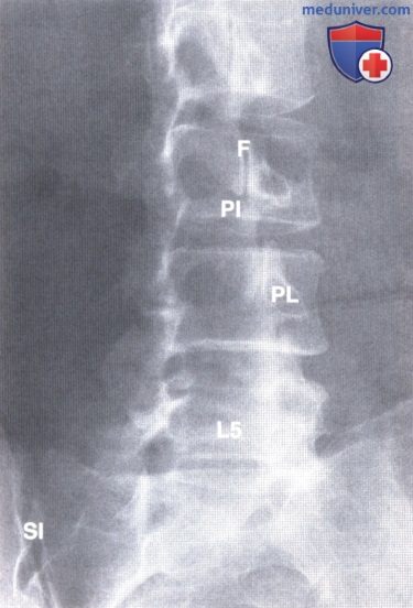 Примеры рентгенограмм, МРТ пояснично-крестцового отдела позвоночника