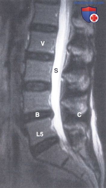 Примеры рентгенограмм, МРТ пояснично-крестцового отдела позвоночника