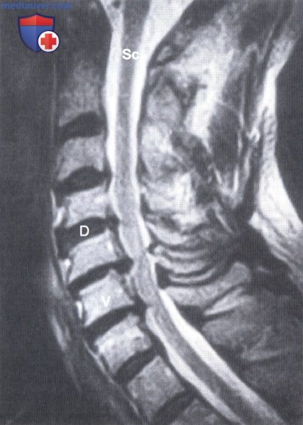Примеры рентгенограмм шейного отдела позвоночника в норме