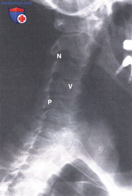 Примеры рентгенограмм шейного отдела позвоночника в норме