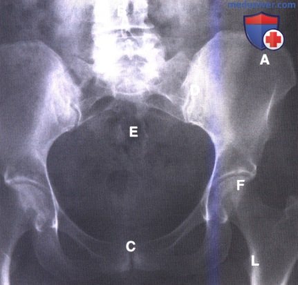 Примеры рентгенограмм тазобедренного сустава