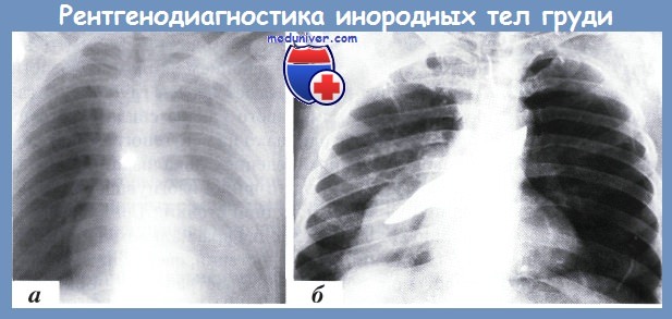 рентгенодиагностика инородных тел груди