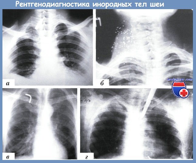 рентгенодиагностика инородных тел шеи