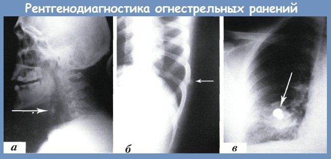 рентгенодиагностика огнестрельных ранений