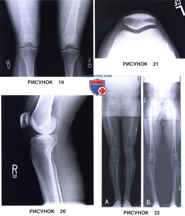 Рентгенологическая оценка коленного сустава