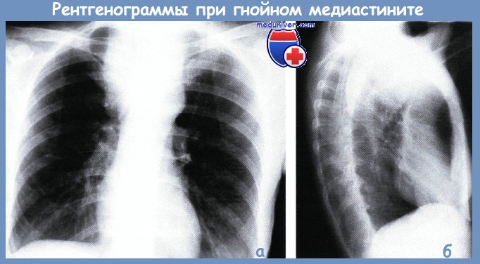 рентгенограмма при медиастините
