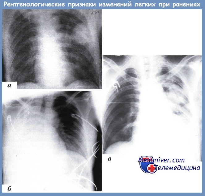 Рентгенодиагностика повреждений органов шеи, грудной клетки