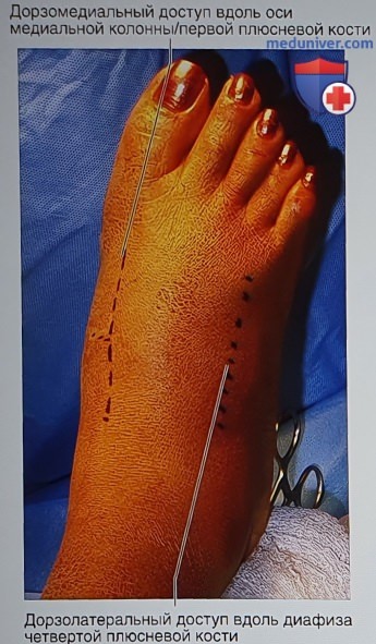 Операция открытая репозиция и внутренняя фиксация при повреждениях Лисфранка, предплюсне-плюсневых суставов