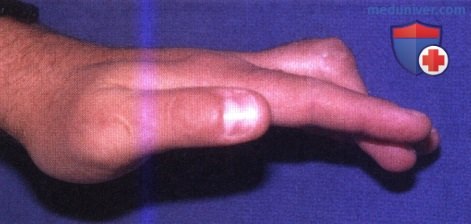 Сгибательная контрактура проксимального межфалангового сустава (ПМФС)