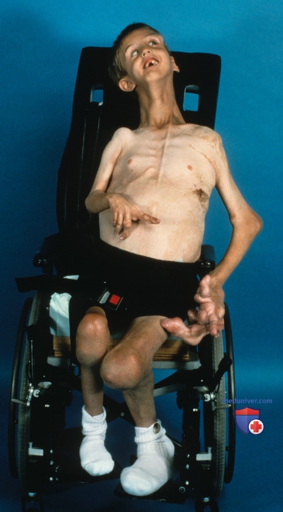 Синдром Протея (Proteus) - краткая характеристика