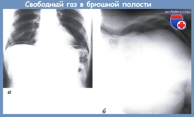 свободный газ в брюшной полости - рентгенограмма