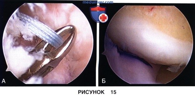 Доступ и техника артроскопически ассистированной аллотрансплантации мениска коленного сустава